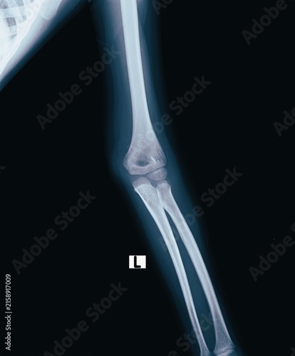 Canvas Print AP and lateral elbow joint X-ray scan showing humerus radius and ulna articulati