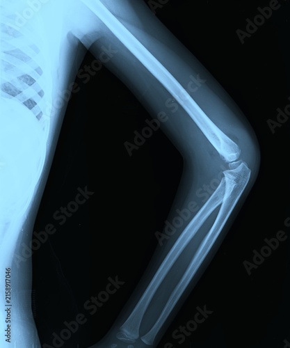 Canvas Print AP and lateral elbow joint X-ray scan showing humerus radius and ulna articulati