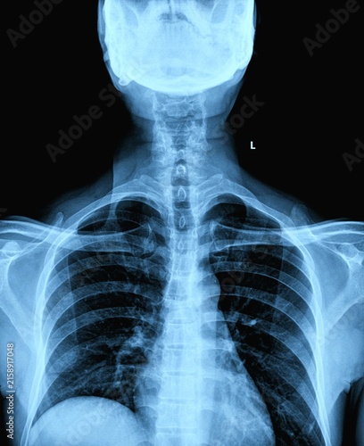 Cuadro en lienzo Cervical spine X-ray radiograph AP and lateral view showing neck vertebrae anato