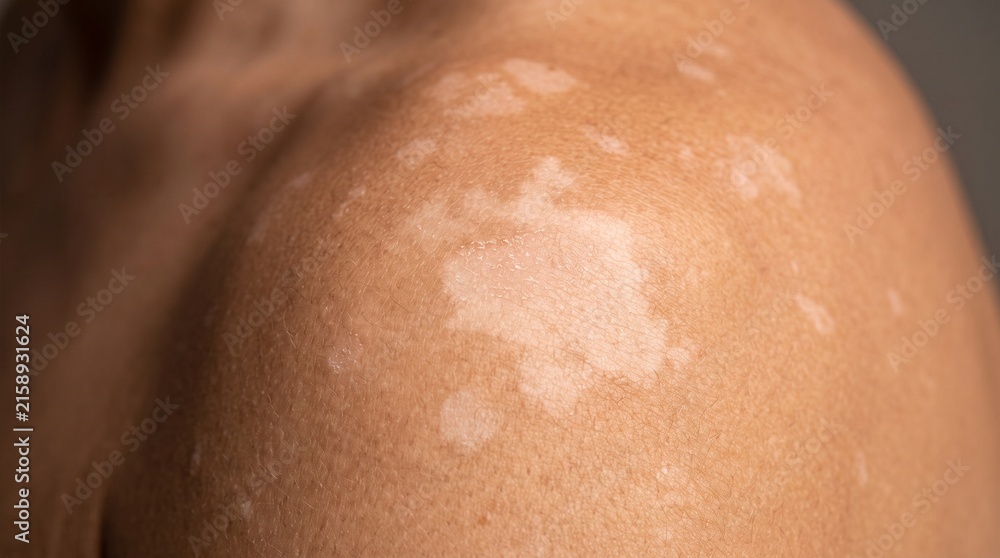 Fototapeta premium Detailed close-up view of a human shoulder and arm exhibiting noticeable white depigmentation patches on the skin, a characteristic of various dermatological conditions