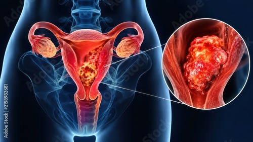 Female reproductive system showing uterine cancer tumor with enlarged closeup. Medical anatomy illustration for oncology diagnosis, gynecology education, cancer awareness and healthcare research.