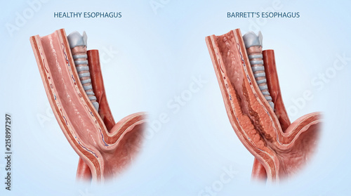 3D Medical Illustration Comparing Healthy and Barrett's Esophagus Anatomy