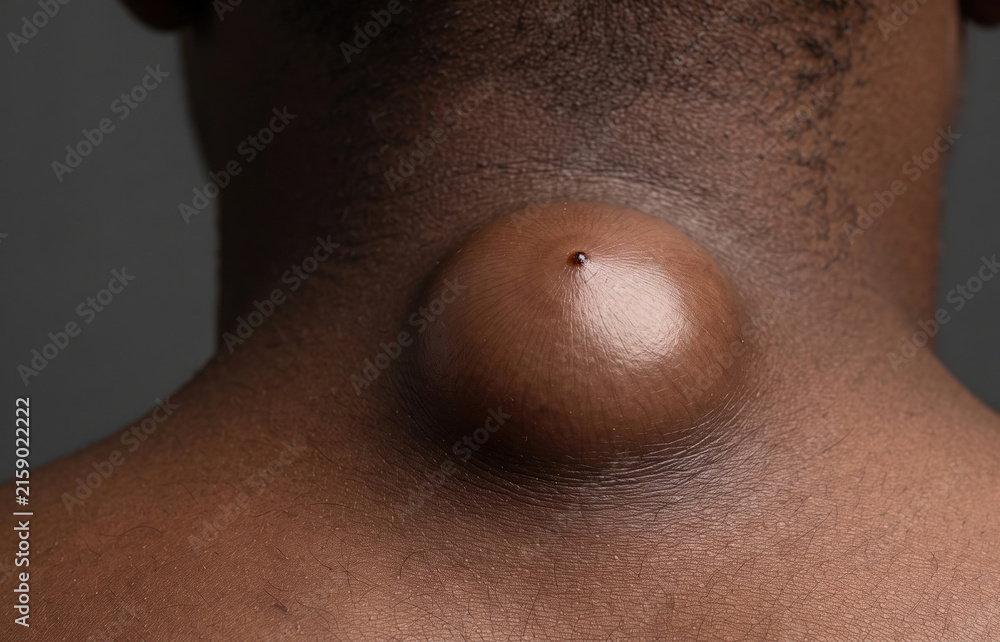 Naklejka premium Macro view of a large epidermoid cyst or sebaceous cyst on dark skin neck