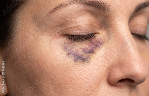 Extreme close up of a severe dark purple bruise and black eye trauma on female face
