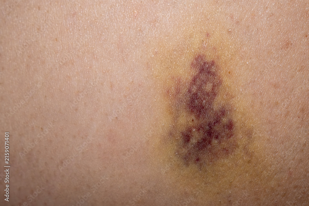 Fototapeta premium Close Up of a Bruised Skin Area. Skin Hematoma with Purple and Blue Discoloration. Visible Bruising on Human Skin.