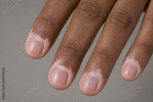 Periungual Vitiligo Around Fingernails on Dark Skin