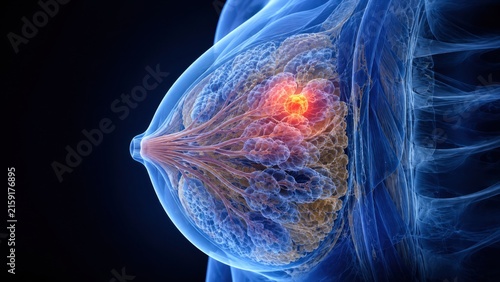 Blue glowing anatomical render of breast with bright red malignant tumor highlighting pathology.