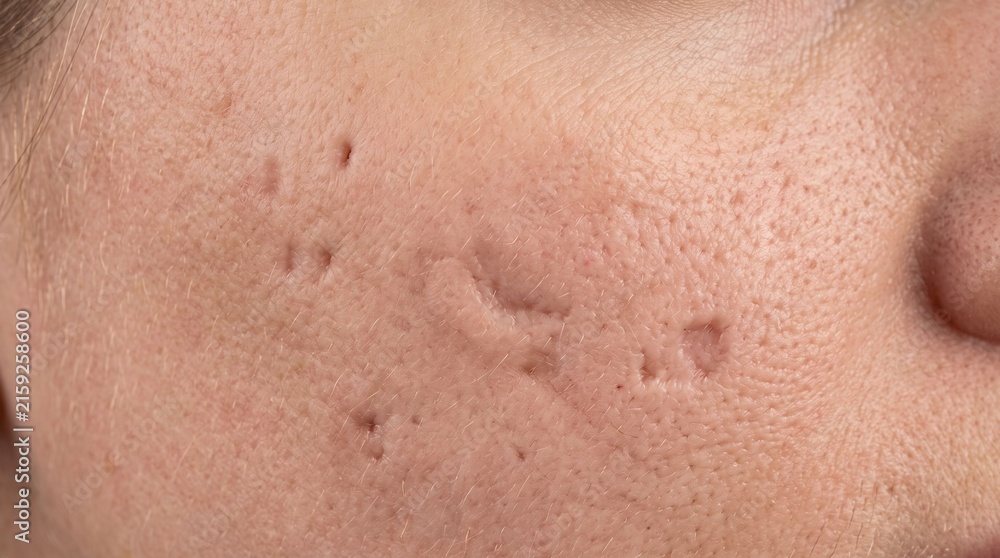 Fototapeta premium Close up of pitted acne scars and large pores on cheek