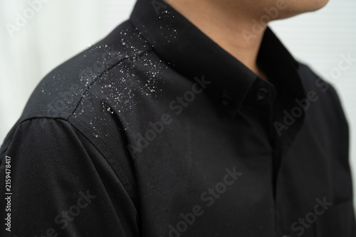 Quadro su tela Man with dandruff on shirt at shoulder.