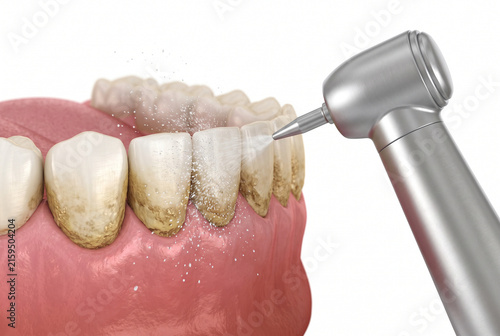 Procedimiento de limpieza dental con instrumento profesional
