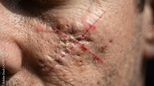 scar, skin, face, burn, injury, trauma, mark with red lines and textured detail for medical background and forensic illustration