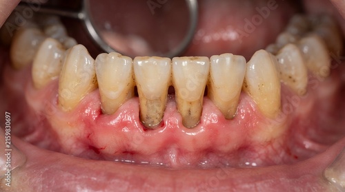 Severe gum recession with exposed tooth roots and periodontal disease in dental close up.