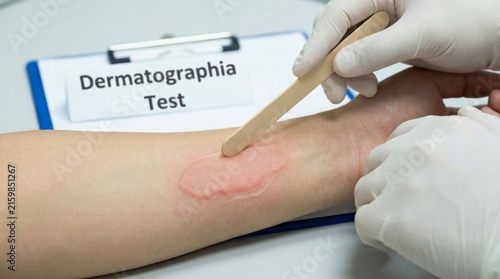 Dermatographia Test for skin allergy with a medical instrument on a human arm with a red reaction.