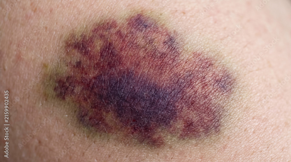 Fototapeta premium Fotografía médica macro de alta resolución, primer plano íntimo centrado puramente en un hematoma y contusión subcutánea significativa sobre piel humana