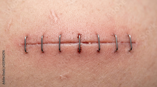 Fotografía médica macro de alta resolución, primer plano extremo centrado en una incisión quirúrgica reciente cerrada con grapas estériles sobre piel humana