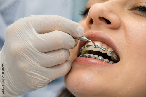 Close-up of an orthodontist adjusting metal braces on a patient’s teeth, representing orthodontic treatment and dental care