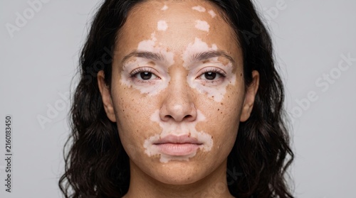 Portrait of a beautiful young woman with vitiligo skin condition on her face looking at camera