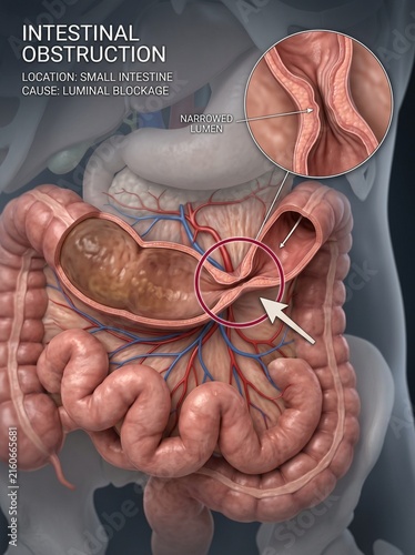 Medical Illustration of Small Intestinal Obstruction with Narrowed Lumen Detail