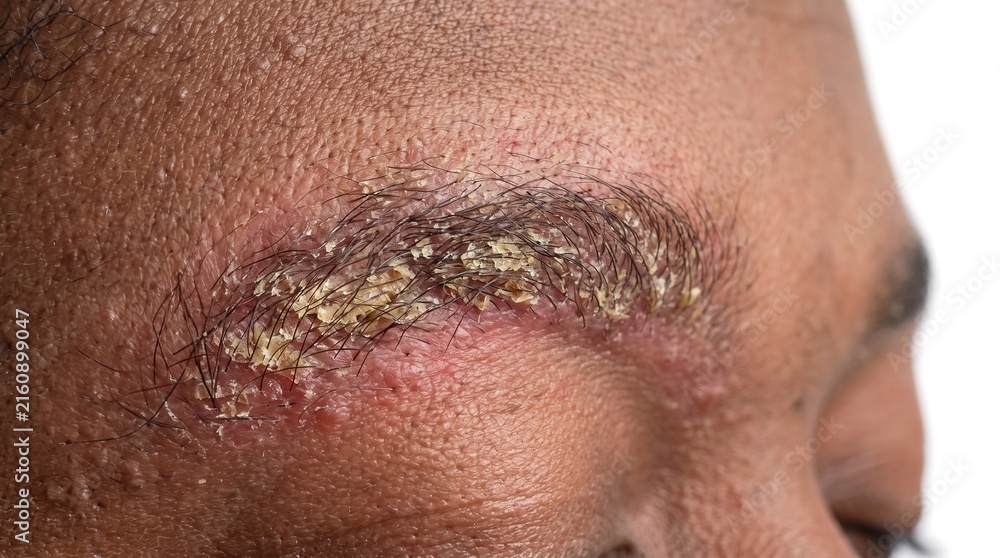 Fototapeta premium Severe seborrheic dermatitis flaking yellowish crusts and inflammation on male eyebrow