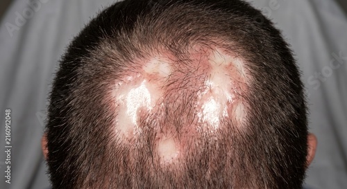Top view of scalp showing severe scarring alopecia and hair loss patches