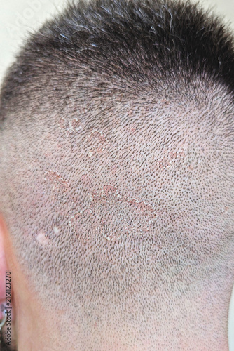 Close-up of shaved scalp with visible dandruff, dry flakes and peeling skin, detailed view of irritated scalp surface and short hair