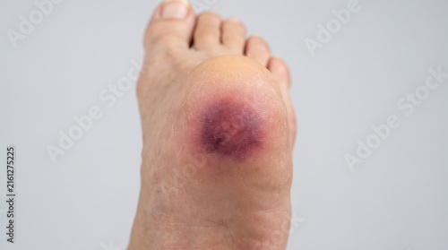 Close up of human heel with severe purple bruise plantar hematoma or diabetic foot complication