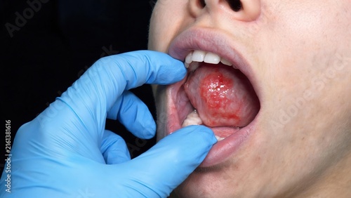Oral Cancer, Medical Illustration Showing Pathological Lesions and Tumor Tissue Inside Human Oral Cavity Structure