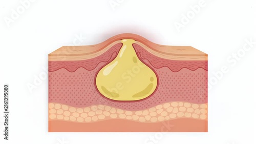 Skin Inflammation Diagram Pimple Growth.