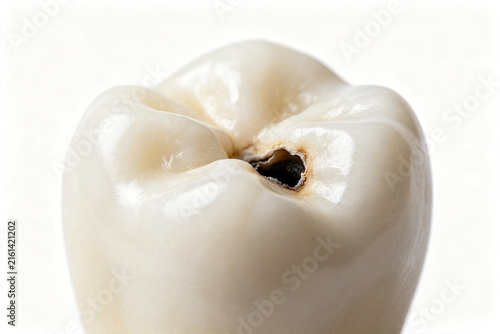 Cross-section illustration showing tooth decay progressing through enamel, dentin, and pulp layers.