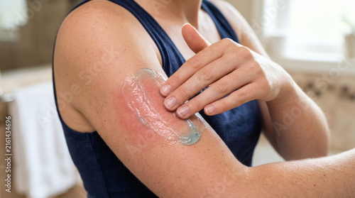 A person is applying cooling gel to a sunburned arm in a bathroom with a towel in the background.