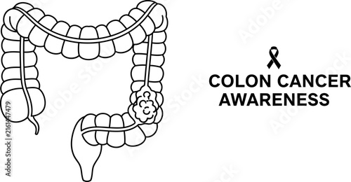 Vector illustration of human large intestine with a tumor, accompanied by the text 
