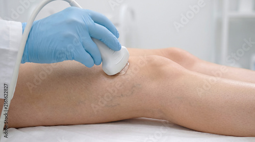 Doctor with blue gloves scans a leg with spider veins using an ultrasound probe for vascular diagnosis
