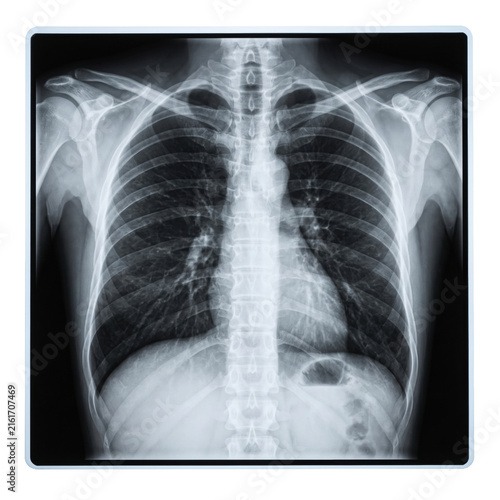 Obraz na płótnie Human chest X-ray radiograph scan on transparent background
