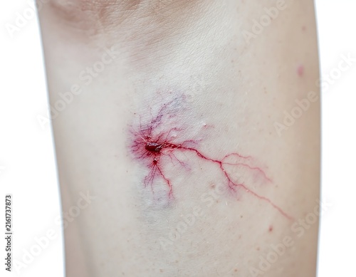 Close up of a minor skin abrasion on torso.