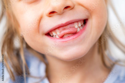 Canvastavla happy positive funny toothless 6-year-old girl, Close-up smiling child's face, s