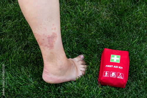 Obraz na płótnie Bruised Leg Beside Red First Aid Kit on Grass