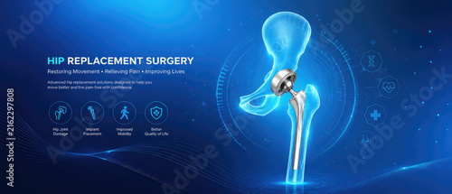 Hip Replacement Surgery Medical Infographic with Advanced Hip Implant Technology