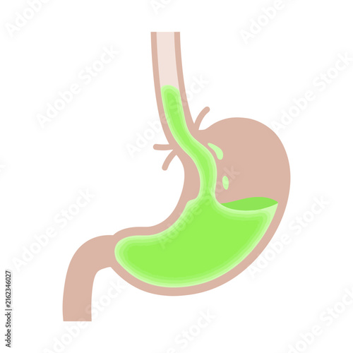 Foto Medical illustration of human stomach showing acid reflux and heartburn symptoms