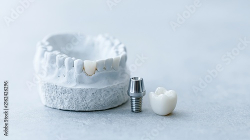 Dental implant model with crown and abutment