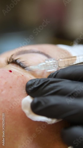 Injections of skin-lifting treatments. Mesotherapy. Close-up of female face during youth restoration and facial rejuvenation procedure - Vertical Video