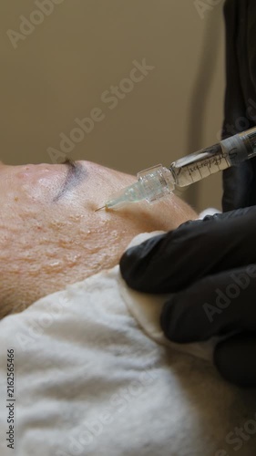 Injections of skin-lifting treatments. Mesotherapy. Close-up of female face during youth restoration and facial rejuvenation procedure - Vertical Video