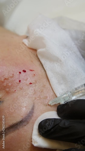 Injections of skin-lifting treatments. Mesotherapy. Close-up of female face during youth restoration and facial rejuvenation procedure - Vertical Video