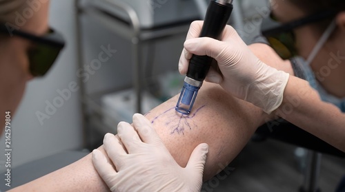Dermatologist performing vascular laser treatment on a patient's calf for spider vein removal.