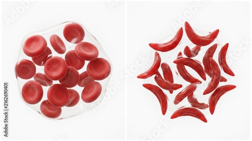 Close-Up View of Red Blood Cells in Healthy and Sickle-Shaped Forms