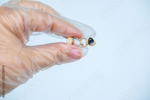 dentist hand in latex glove holding Three-unit dental bridge, structure of dental prosthetics, metal framework, medical technology, laboratory work, and the scientific approach to dental restoration