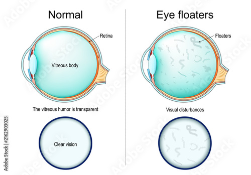 Posterior vitreous detachment PVD. Cross section of human eye