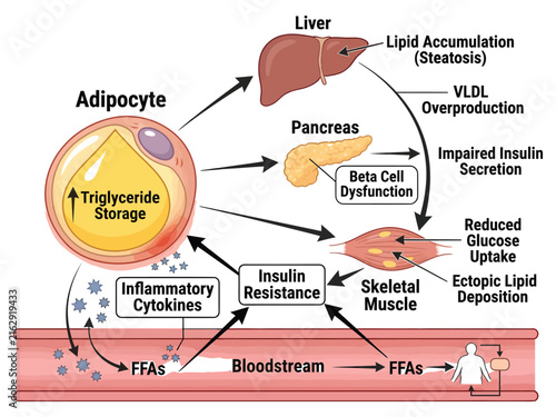 Bild auf Leinwand Insulin resistance and metabolic dysfunction diagram Vector