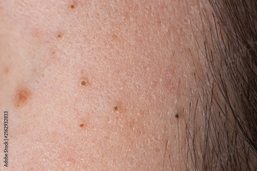 Obraz na plátně Close up epidermis with inflamed follicles and acne