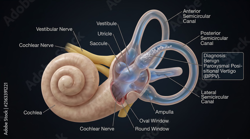 Inner ear inner structure diagram showing canalithiasis in benign paroxysmal positional vertigo BPPV