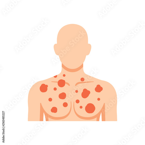 Human torso vector illustration showing red circular skin rash symptoms